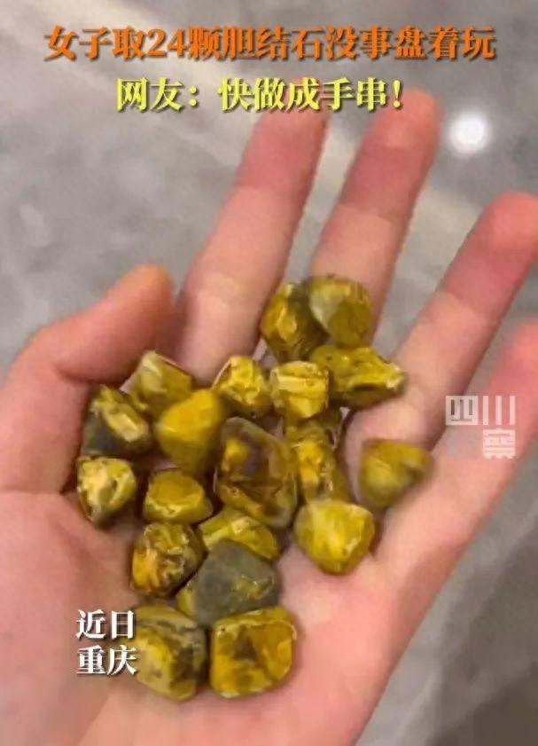 女子取24颗胆结石没事盘着玩！